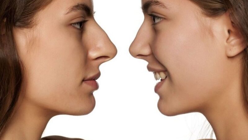 How To Reduce Nose Fat Naturally at Home